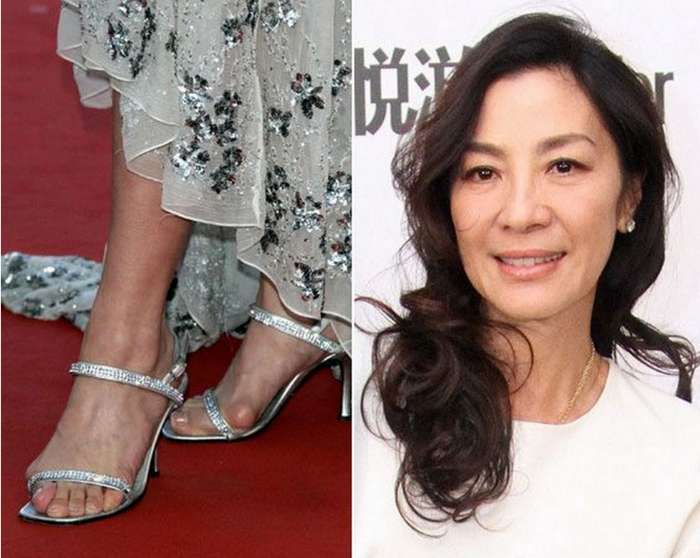 Celebrities with Bunions 2