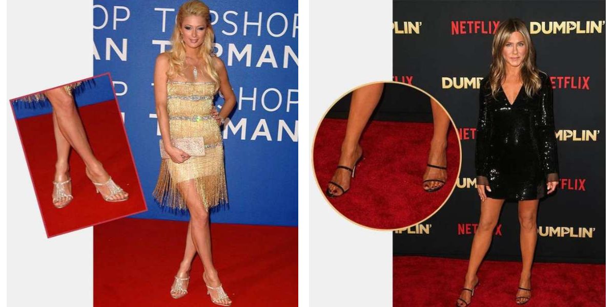 Celebrities with Bunions
