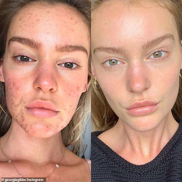 Models With Rosacea