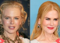 Nicole Kidman Plastic Surgery Before & After