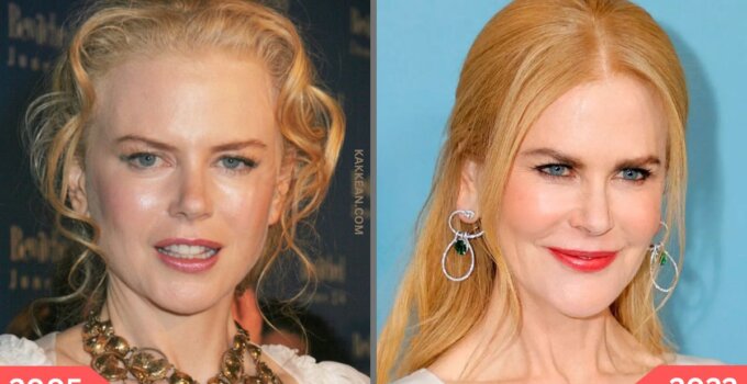 Nicole Kidman Plastic Surgery Before & After