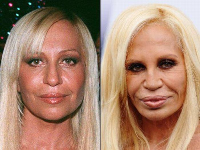 The Worst Celebrity Plastic Surgery