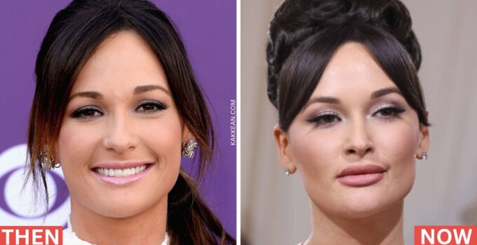 Kacey Musgraves Plastic Surgery Before & After