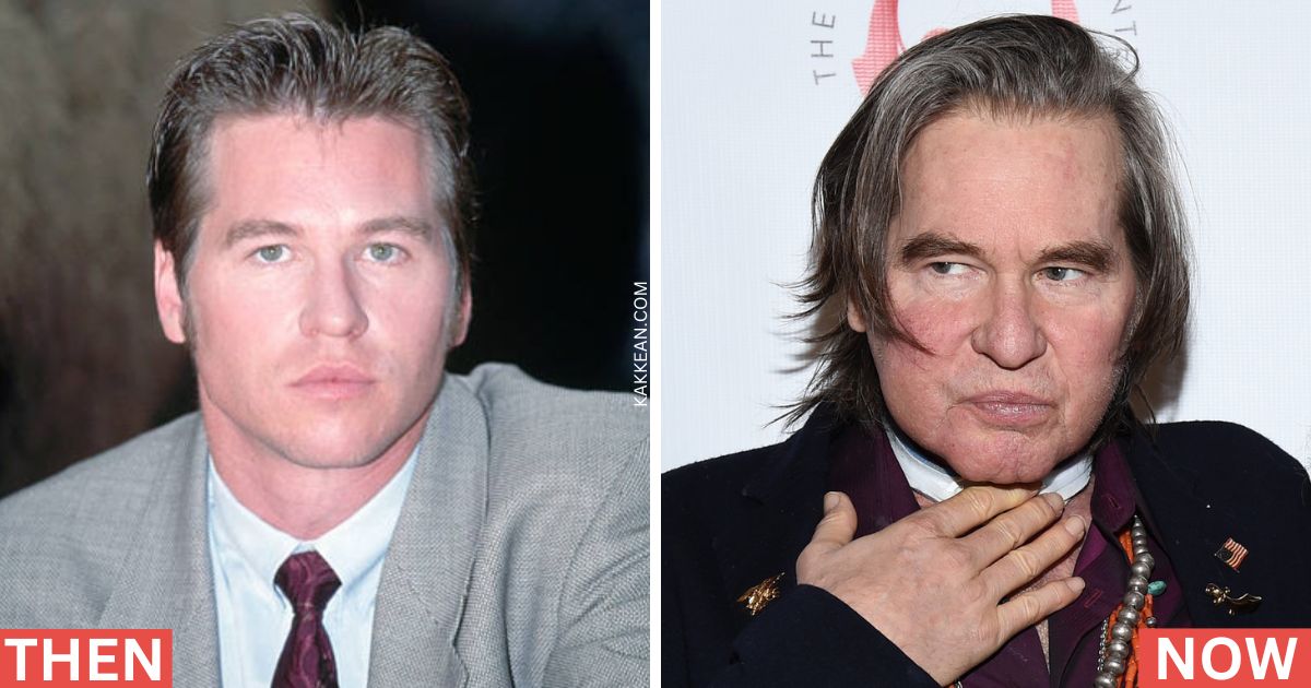 Val Kilmer's Plastic Surgery Before & After