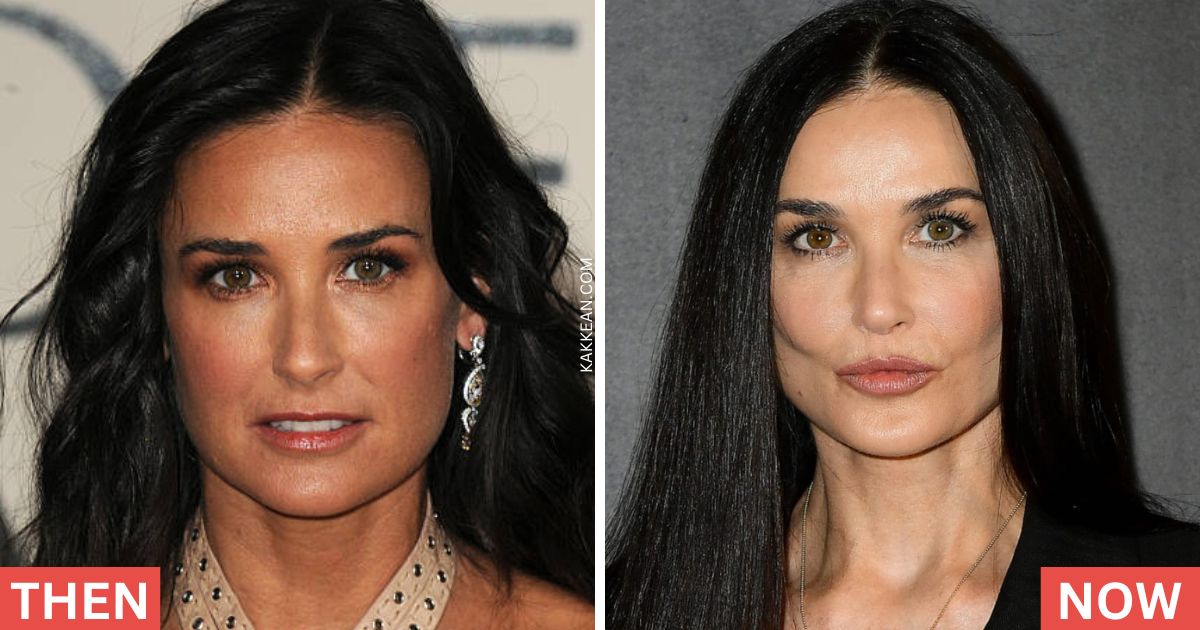 Demi Moore's Plastic Surgery Before and After
