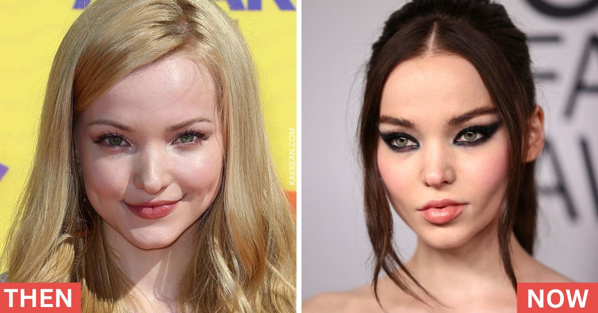 Dove Cameron's Plastic Surgery Before & After