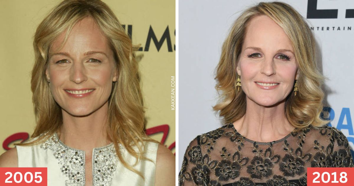 Helen Hunt's Plastic Surgery Before & After