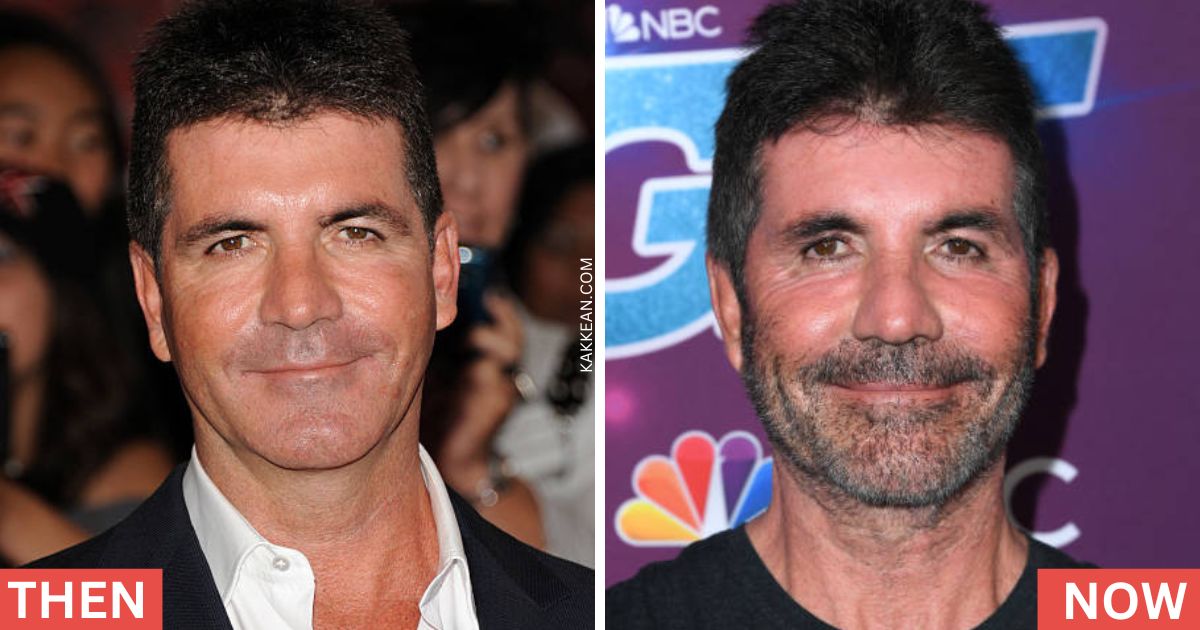 Simon Cowell's Plastic Surgery Before & After