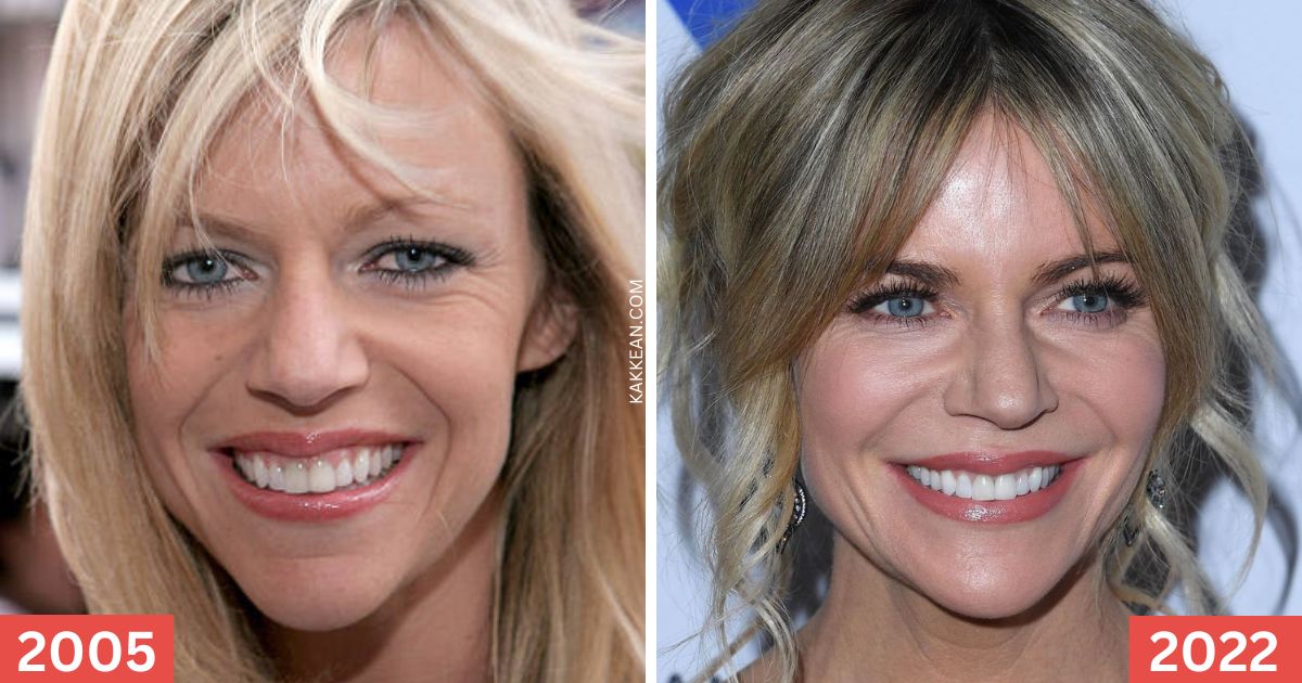 Kaitlin Olson Plastic Surgery Before & After