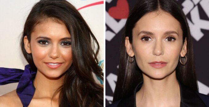 Nina Dobrev Plastic Surgery Before & After