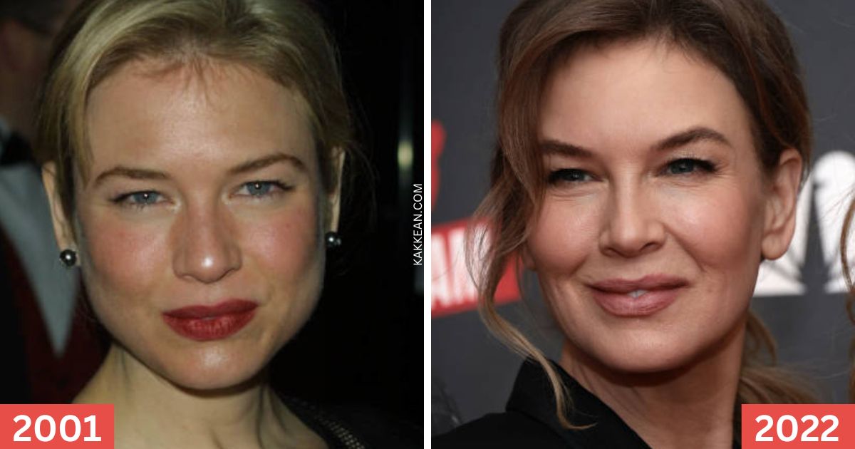 Renee Zellweger's Plastic Surgery Before & After